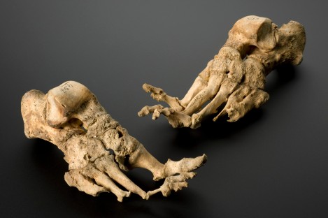 Skeleton, mature female, showing effects of leprosy, from a medieval Danish leprosy cemetary, reputedly c.1350. Credit: Science Museum, London. Wellcome Images images@wellcome.ac.uk